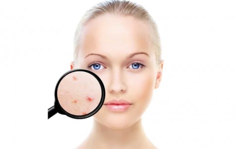 Bạn Đã Biết Trị Mụn Đúng Cách Chưa?