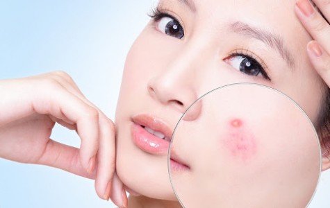 Vì Sao Mụn Nổi Liên Tục Và Cách Trị Hiệu Quả